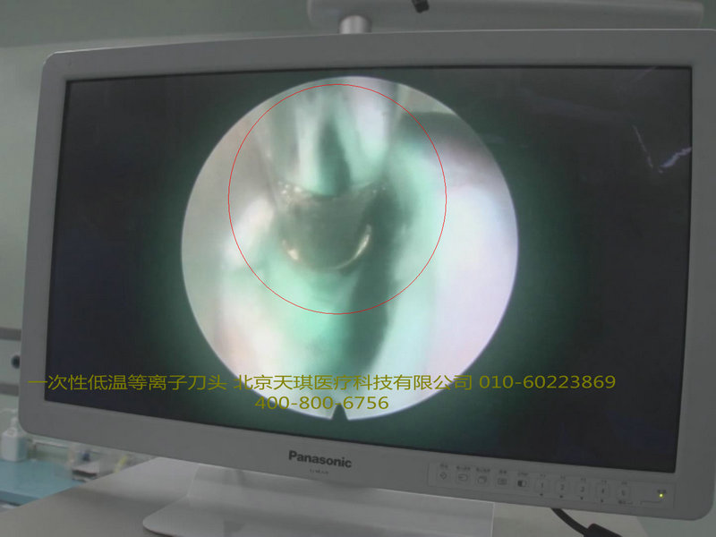 一次性使用等離子刀頭價(jià)格，低溫等離子刀頭，雙極射頻手術(shù)刀頭，等離子刀頭